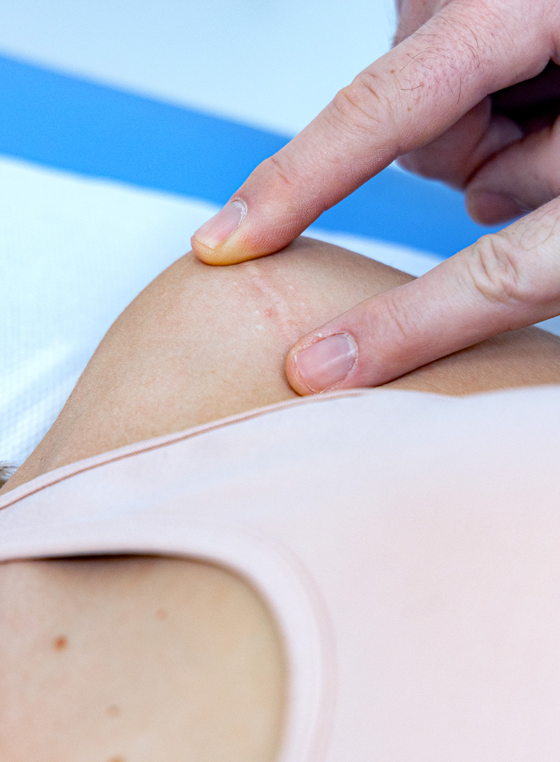 Tecnica MSTR applicata su tessuto cicatriziale per migliorare funzionalità, mobilità e aspetto della cicatrice